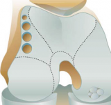 Osteochondral Autograft Transfer System (OATS)