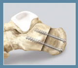 6.7 mm Low Profile Screw System