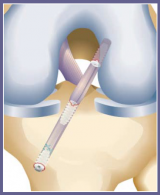 RetroScrew for Femoral and Tibial Fixation in Transtibial ACL Reconstruction