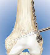 Femoral Opening Wedge Osteotomy System