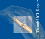 2.5 mm PushLock 3 mm x 8 mm Bio-Tenodesis Thumb Collateral Ligament Repair/Reconstruction