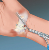 Endoscopic Carpal Tunnel Release System