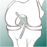 Transtibial PCL Reconstruction