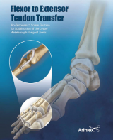 Flexor to Extensor Tendon Transfer – Bio-Tenodesis