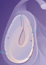 Arthroscopic Glenoid Resurfacing with a Meniscal Allograft