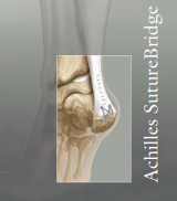 Achilles SutureBridge