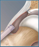 Acetabular Labral Repair using the PushLock Knotless Anchor System