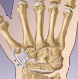Ligament Reconstruction – Tendon Interposition for Thumb CMC Arthritis