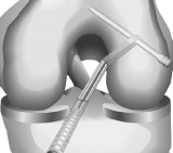 Medial Portal TransFix Hooks for Anatomic Femoral ACL Fixation