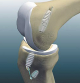 ACL Transtibial Reconstruction Using Soft Tissue Grafts