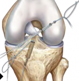 Determinator – The Determinator graft length guide confirms appropriate graft length