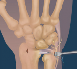 Arthroscopic Repair of the Triangular Fibrocartilage Complex (TFCC) with the Micro SutureLasso