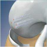 Osteochondral Flap Repair System with Chondral Dart