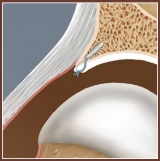 Acetabular Labral Repair using the Bio-SutureTak Suture Anchor System