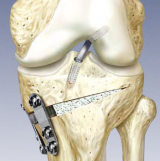 High Tibial Opening Wedge Osteotomy System using Modular-Biplanar Plates and OSferion B-TCP Osteotomy Wedge