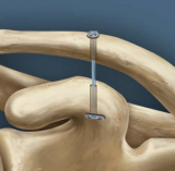 Arthroscopic Stabilization of Acute Acromioclavicular Joint Dislocation using the TightRope System