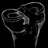Dovetail Meniscal Allograft Technique