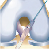 Double Bundle ACL Reconstruction with Bioabsorbable RetroScrew Fixation