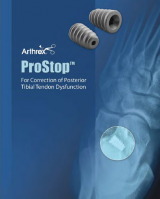 ProStop – For Correction of Posterior Tibial Tendon Dysfunction