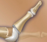 AnaToemic Phalangeal Prosthesis