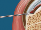 Arthroscopic Diagnosis and Repair of Partial-Thickness Rotator Cuff Tears Using the PASTA Depth Guide