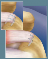 SwiveLock & FiberChain Knotless Rotator Cuff Repair