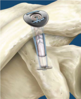 Stabilization of Acromioclavicular Joint Dislocation using the AC GraftRope System