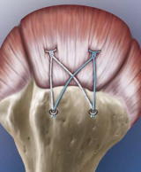 SutureBridge Double Row Rotator Cuff Repair Using the PushLock and Bio-Corkscrew FT