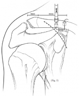 Anatomic Coracoclavicular Reconstruction