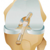 Transtibial ACL Reconstruction System for BTB Grafts