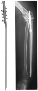 Ulna-radius nail