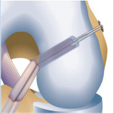RetroButton for Femoral ACL Reconstruction and RetroConstruction