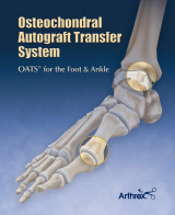 Osteochondral Autograft Transfer System – OATS for the Foot & Ankle