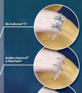 Fulfilling the Need for Precision and Speed – Rotator Cuff Repair