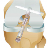 Bio-TransFix ACL Reconstruction